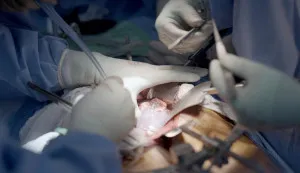 The first patient transplanted with a pig kidney is discharged in Boston